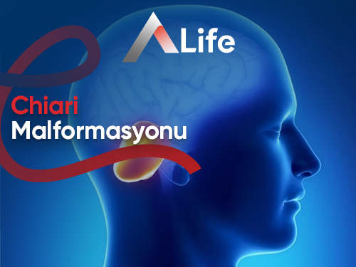 Chiari Malformasyonu